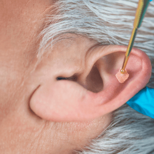 Curso de Auriculoterapia Básico